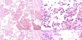 Protegido: Contenido del Simposio de Tumores neuroendocrinos